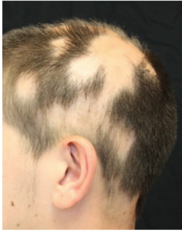 capilike - alopecia areata