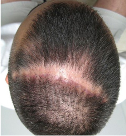 capilike - alopecia cicatricial